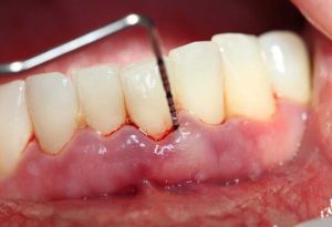 Disadvantages of Deep Cleaning Teeth