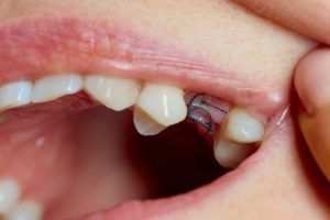 Dissolvable Wisdom Stitches