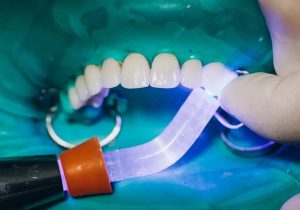 Extended Maintenance for Dental Veneers