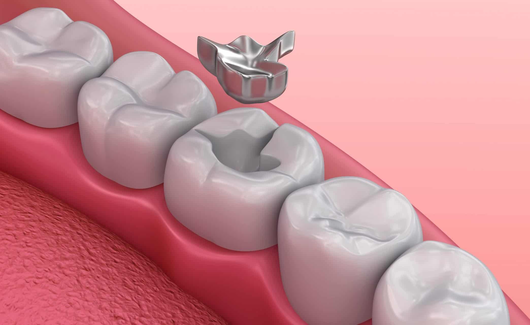 Dentist filling a patient's cavity during a routine appointment