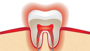 Gum and tooth sensitivity