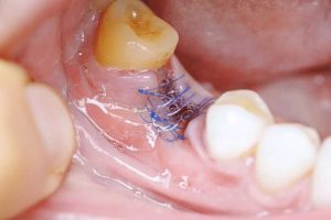 Wisdom Teeth Stitches