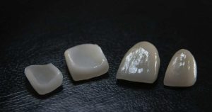 Dentistry Veneers: Pros and Cons