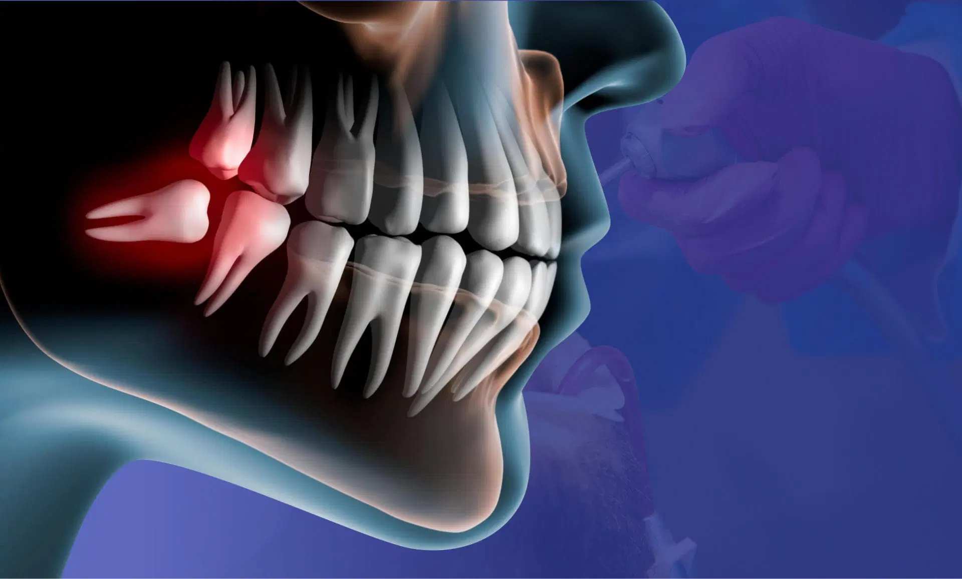 Can Wisdom Teeth Grow Back
