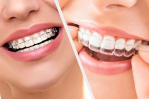 Alternatives to Teeth Lengthening