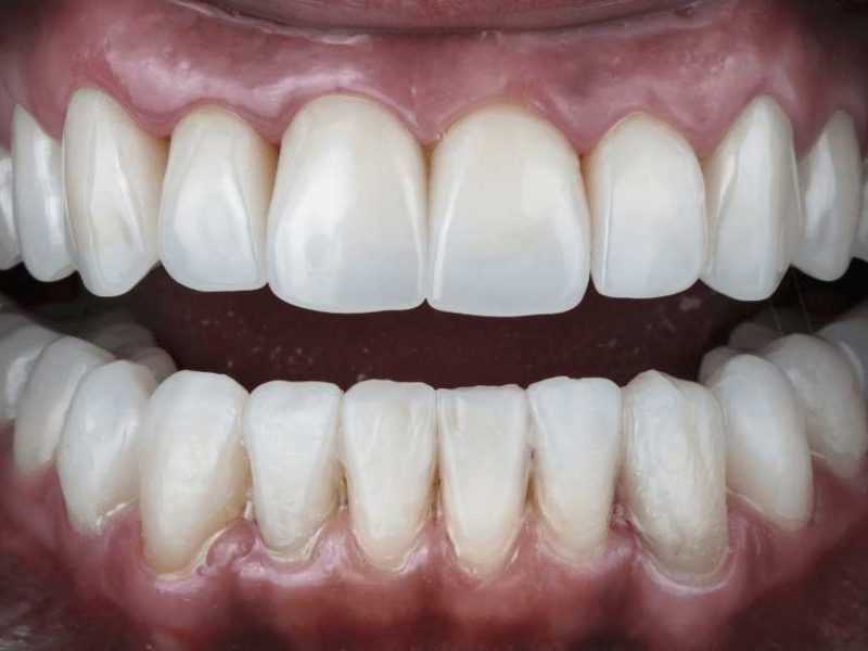 Teeth Lengthening